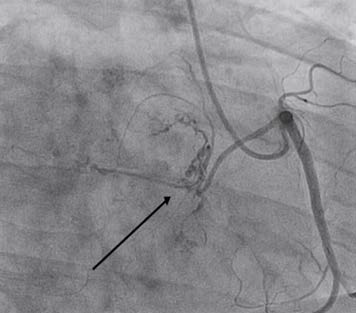 Coronary angiography, performed as part of preoperative planning, showed normal coronaries. However, the right coronary artery on a right anterior oblique view (2A) showed a large vessel arising from the paraostial segment of the right coronary artery, seen feeding the tumor with large vascular channels, which retained the contrast for a long time. This finding raised the suspicion of a vascular tumor, namely hemangioma.