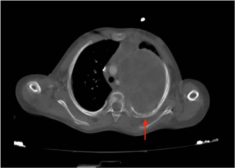 Diagnosis of PES with CT after the first ICA.