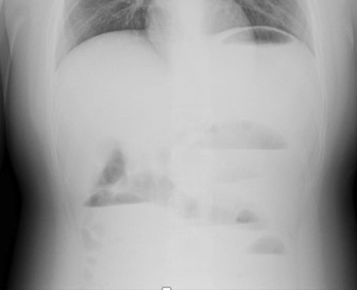 Plain radiograph of the abdomen showing dilated loops of bowels with air-fluid levels in the upper abdomen, predominantly on the left