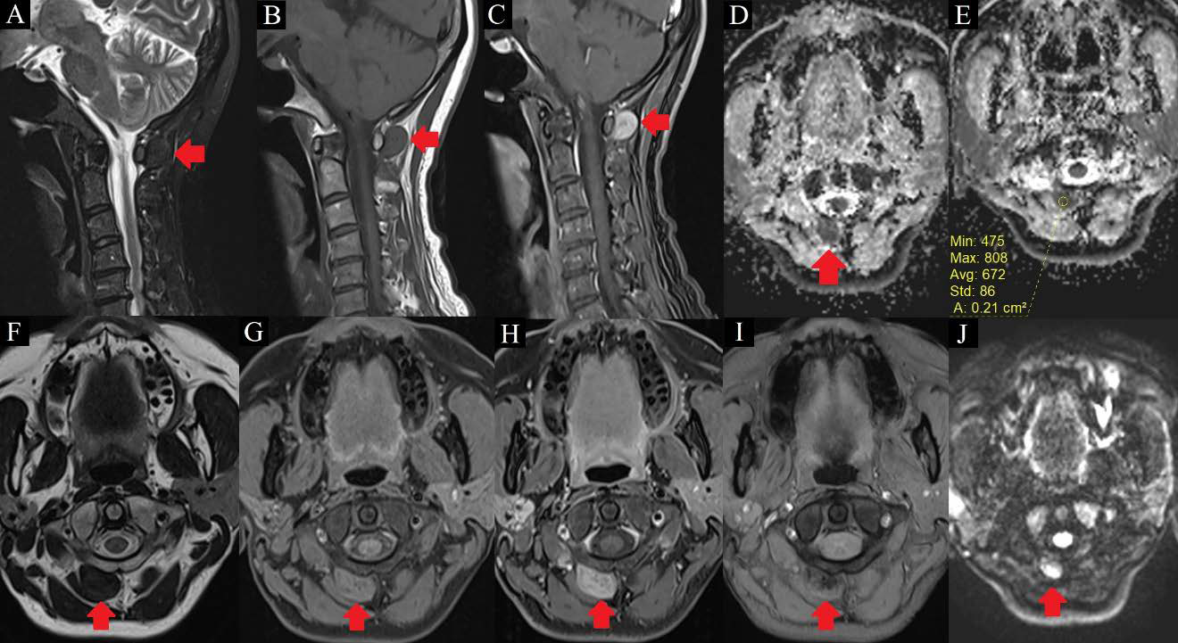 MRI images of a 54 year-old lady with tenosynovial giant cell tumor at the upper cervical spine, likely arising from the posterior atlantoaxial membrane.