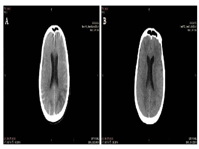 83-year-old female with pseudo subarachnoid hemorrhage. (A) The head CT showing diffuse high-density areas in the subarachnoid