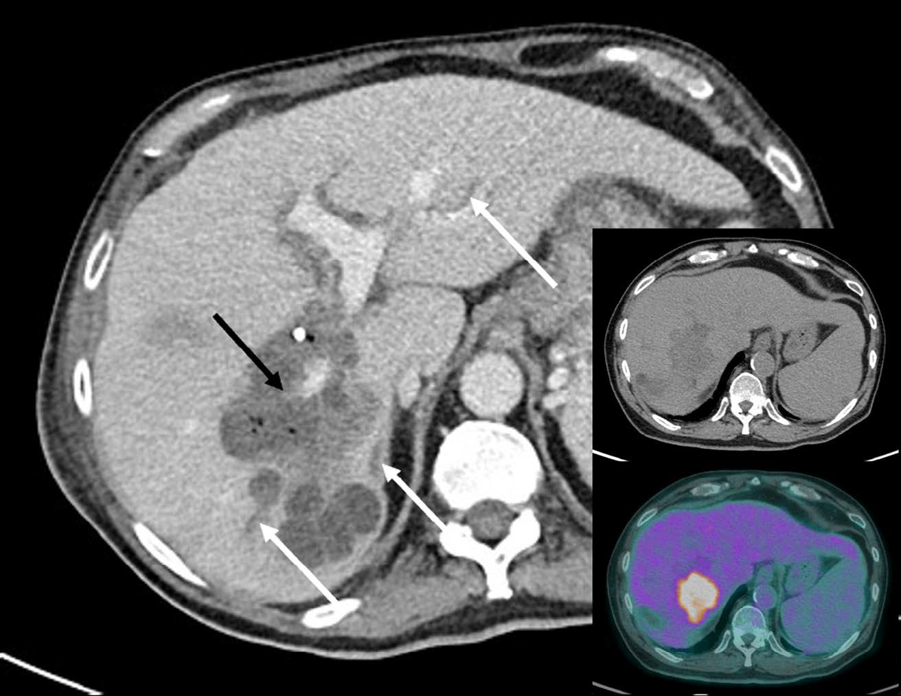 The right hepatic lobe tumor (hepatic lymphoma) is noted with gas foci within the necrotic component. The right portal vein courses through the necrotic mass and appears attenuated (black arrow). Several dilated intrahepatic ducts are seen connected to the necrotic mass (white arrows). Image insets: Preceding positron emission tomography computed tomography (PET CT) images which demonstrates a fluorodeoxyglucose (FDG)-avid right hepatic lobe mass.