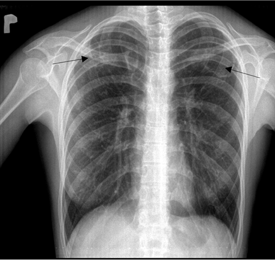 Chest X-ray showing cavernous lesions (black arrows) and nodules.