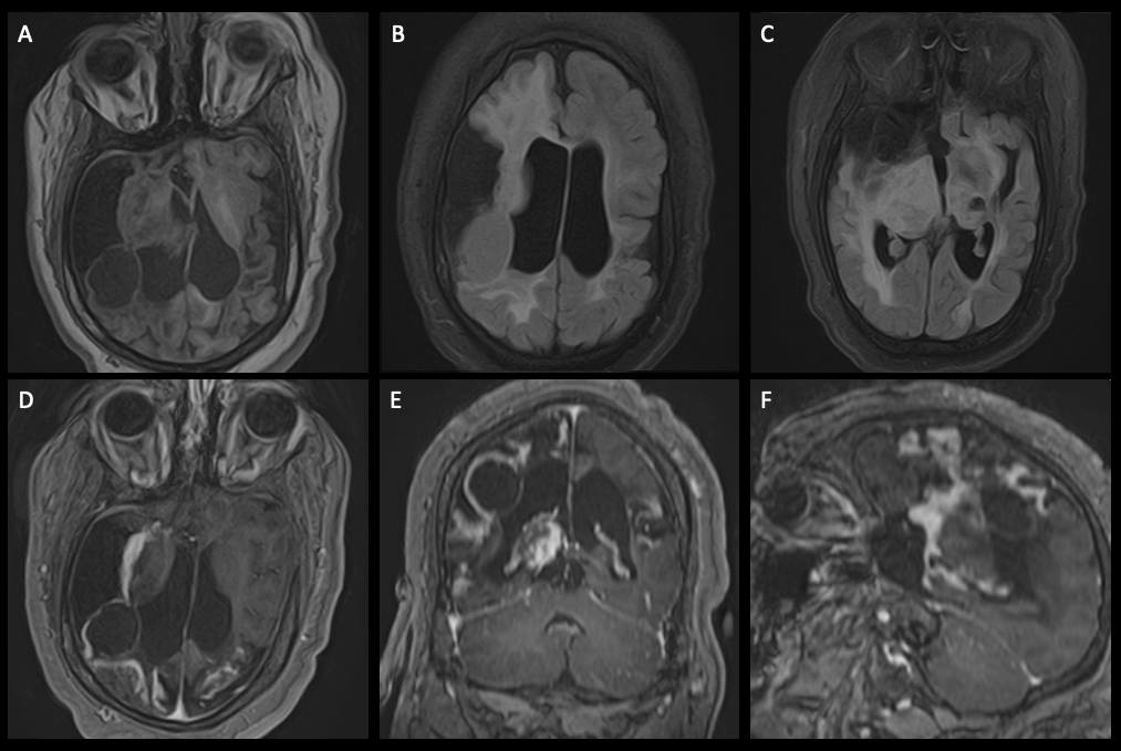 14 year old female with recurrent HSV encephalitis