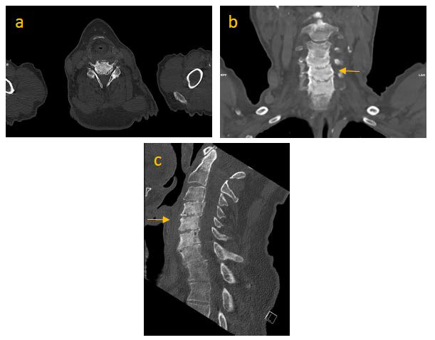 Computrized Tomography (CT) of vertebral column (a-c). Axial view at C5-level (a). Coronal view; C5 of the cervical spine is highlighted by an arrow. Saggital view; C5 of the cervical spine is highlighted by an arrow. Accentuated extensive sclerosis of cervical vertebrae is detected.