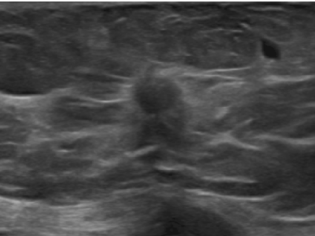 Left breast US. A disomogeneous ipoechoic lesion with irregular margins sospicious for malignancy. Biopsy confirms the malignant hypothesis and reveals the presence of an infiltrating ductal carcinoma.