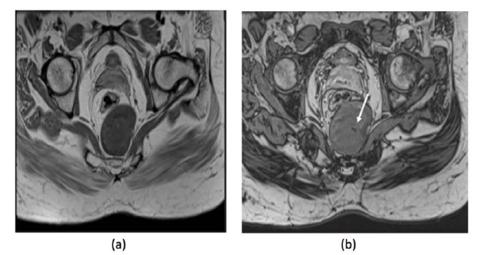 Axial in phase and out of phase MRI images of 43 year old woman with abdominal pain and discomfort