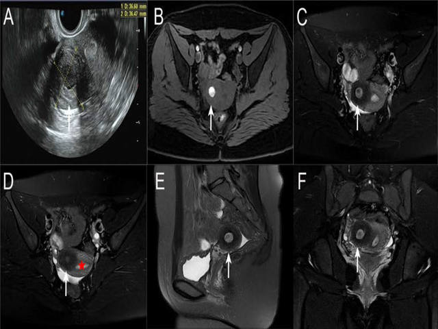 Ultrasonographic, MRI, and pathologic images of an accessory cavitated uterine malformation (ACUM).