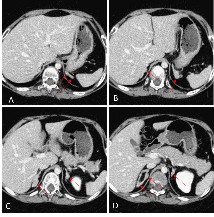 Contrast enhanced CT (A-D, sequential axial scans from cranial to caudal) shows multiple nodular lesions in bilateral adrenal glands (at least 5 on each side, red arrows), with the most prominent ones 1.4 cm on right side and 1.3 cm on left side, compatible with bilateral macronodular adrenal cortical disease.