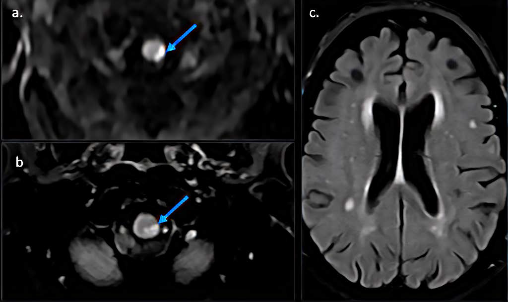 81 years old female with ischemic bulbo-medullary lesion.