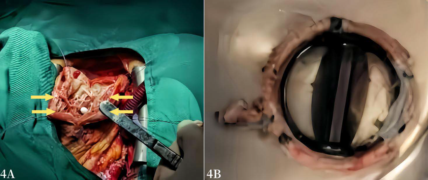 Intraoperative gross findings. 4A shows a giant ventricular aneurysm with many strands; 4B shows the original artificial mechanical aortic valve with a smooth surface and no vegetations