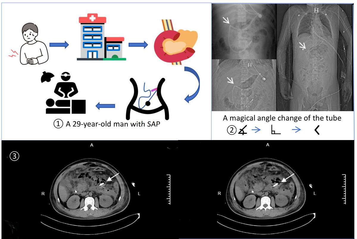 Radiographic changes of the right upper abdomen of the nasointestinal tube indicated duodenal perforation