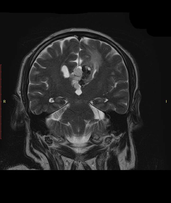 Coronal T2-weighted Magnetic Resonance Imaging (MRI) sequence;