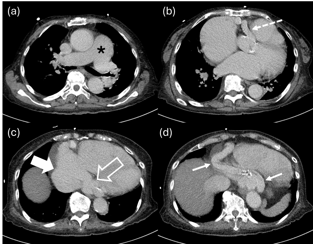 Selected slices from CT pulmonary angiogram – (a) Dilated pulmonary trunk measuring up to 4.3 cm in diameter (asterisk). (b) Origin of dilated RCA measuring up to 1.7 cm in diameter (dashed arrow). (c) Drainage into a dilated distal coronary sinus (hollow arrow) and enlarged right atrium (solid broad arrow). (d) Tortuous course of the RCA (arrows) and inferior vena caval reflux of contrast. CT acquisition details: Siemens, 120kV, 154 mAs, 1 mm slice thickness, 60 ml IV Omnipaque 350