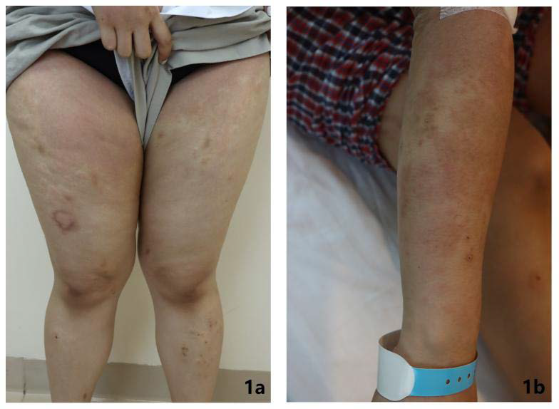 A 29-year-old female with BPDCN presented with scattered flaky edematous erythema, irregular light red wheals, and small flaky brown spots on both lower limbs. Papules were scattered on both sides of the lower legs, with some surfaces covered by dark red scabs (Figure 1a). Large areas of pigmentation and brown spots were observed on the left forearm, along with several scattered dark red papules (Figure 1b).