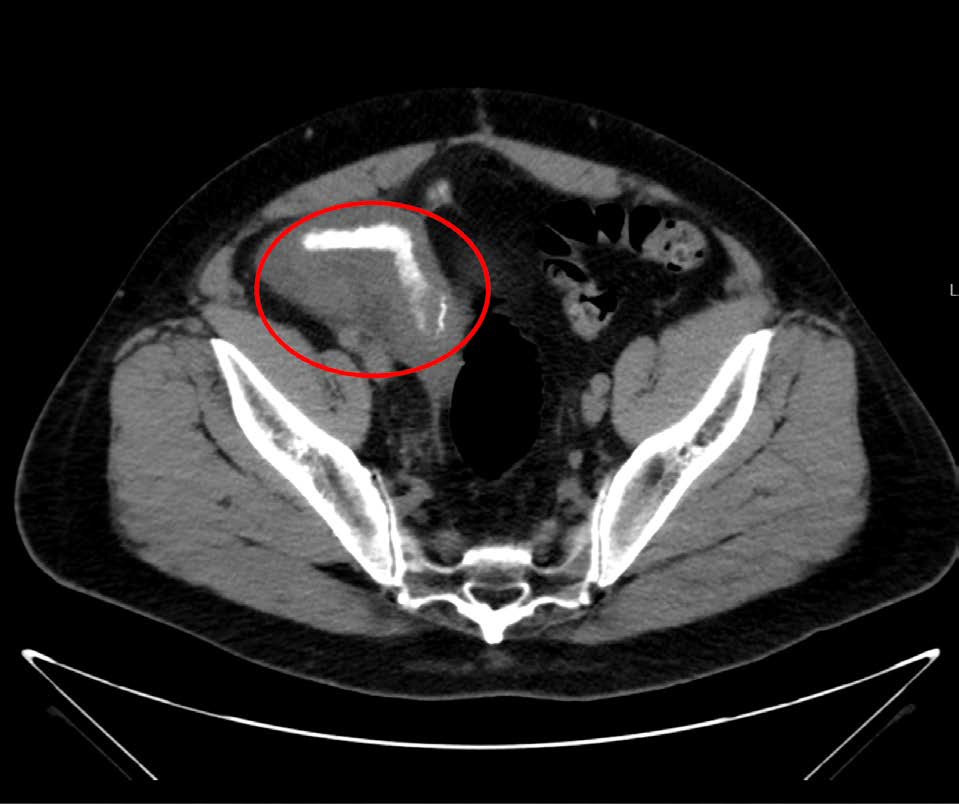 Inflamed Jejunum Marked by red circle on axial CT images