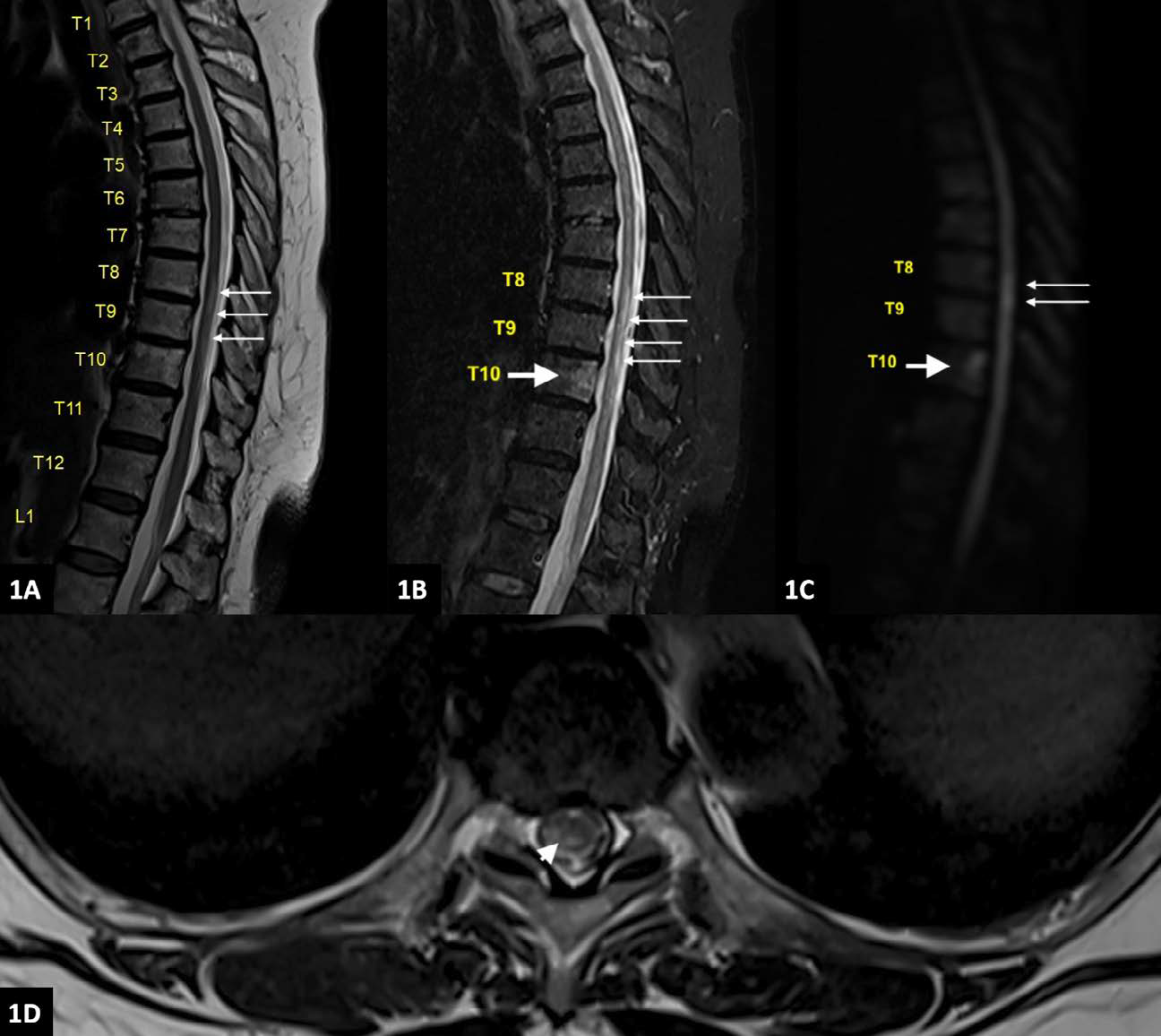 Vertebral Body Infarction – A Useful Imaging Clue in Cord Infarction