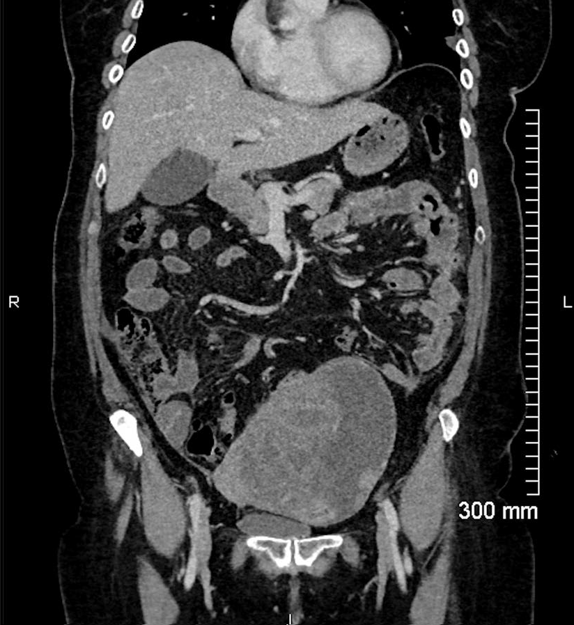 Coronal image from the portal venous phase abdominal CT shows a large pelvic mass measuring 14cm, predominantly solid with some cystic components, and trace free fluid in the pelvis