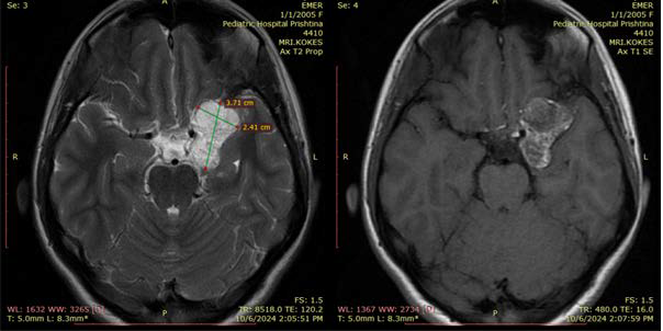 A 19-year old female with epidermoid cyst. FINDINGS: MRI of the brain (pre- and post-contrast) demonstrate a lobulated left frontotemporal basal lesion with hyperintense signal on FLAIR and T2, slight mass effect on the brainstem, and no abnormal contrast enhancement. TECHNIQUE: Axial MRI, TR 480.0, TE 16.0, 5 mm slice thickness, 12ml of Gadopentetate dimeglumine