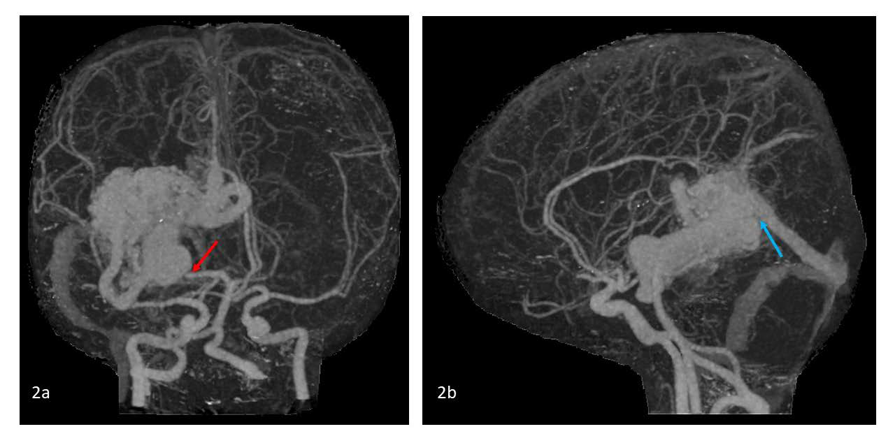 Bag of worms sign. 54 year old male with large cerebral arteriovenous malformation. CT angiography of the Circle of Willis 3D volumerendered reconstruction shows that the arteriovenous malformation is primarily supplied by the right posterior cerebral artery (PCA) (red arrow in 2a) and drains via the vein of Galen and straight sinus (blue arrow in 2b). Toshiba Aquilion One, Slice width 3.0 mm, 120 kV, 114 mAs, Intravenous contrast: 60 ml Omnipaque