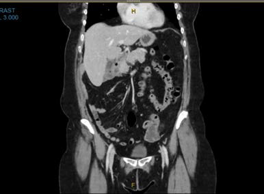 Left (Coronal View): Contrast-enhanced CT image in the coronal plane demonstrates an abnormal arrangement of bowel loops, with the small intestine predominantly located on the right side of the abdominal cavity and the large bowel positioned on the left. This configuration is consistent with intestinal malrotation. No evidence of volvulus or bowel obstruction is observed.