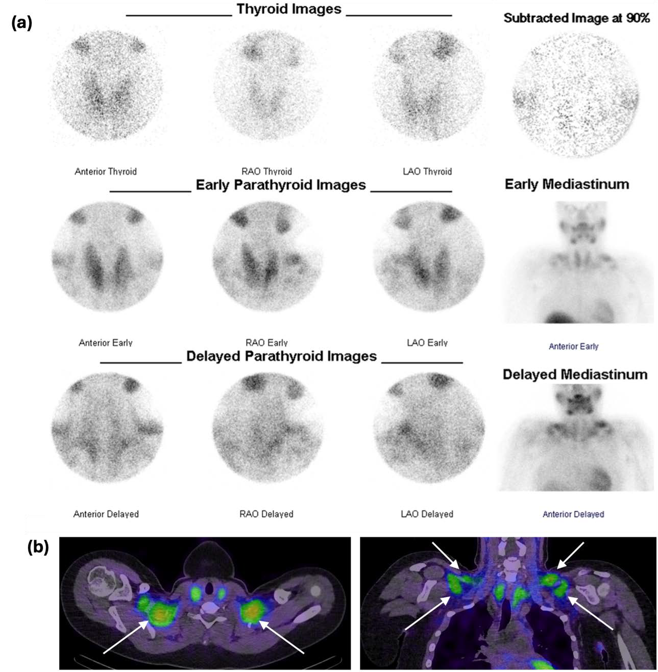 Early and delayed pinhole and planar scintigraphy demonstrating homogenous 99mTc-pertechnetate activity throughout the thyroid and discordant 99mTc-sestamibi activity within the bilateral supraclavicular regions; (b) representative early axial and coronal SPECT-CT imaging with arrows indicating sites of intense 99mTc-sestamibi activity within supraclavicular brown adipose tissue (BAT).