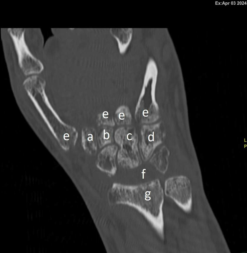 Coronal section – marked osteoporosis. The distal row (trapezium [a], trapezoid [b], capitate [c], and hamate [d] bones) is mostly intact, with no significant fractures and proper alignment relative to each other and the metacarpal bones [e]. The proximal row is essentially absent— there is a visible "gap" [f] between the distal row and the radius [g].
