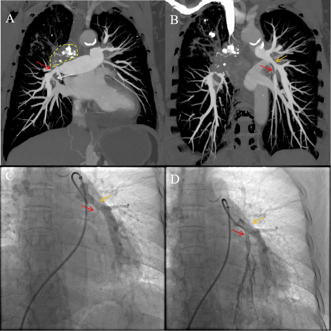 Enhanced computed tomography showed stenosis of pulmonary artery (red arrow) and pulmonary vein (white arrow) compressed by proliferative fibrotic tissues (yellow dots) in mediastinum (A).preoperative CTPA showed stenosis of the left lower pulmonary artery trunk (orange arrow) and severe stenosis of the left pulmonary artery (red arrow) (B).Selective pulmonary artery arteriography showed stenosis of the left lower pulmonary artery trunk (orange arrow) and severe stenosis of the left pulmonary artery (red arrow) (C).Selective pulmonary artery angiography showed stenting in the left lower pulmonary artery trunk (orange arrow) and left pulmonary artery (red arrow) (D).