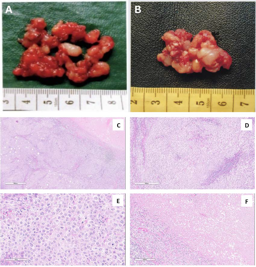 Macroscopic images: (A) Left subclavian lymph nodes of the first incisional biopsy, with a soft consistency and white color, measuring 4x3x0.6 cm. (B) The second excisional biopsy of newly diagnosed swollen lymph node measuring 30x15x5 mm. Histopathological features of primary mediastinal B-cell lymphoma (H&E stain): (C) The tumor exhibits a diffuse and vaguely nodular growth pattern with areas of fibrosis. (D) Tumor cells are arranged in sheets, appearing pale due to the presence of clear cytoplasm. (E) The cells are large with pleomorphic nuclei, coarse chromatin, and a combination of clear and eosinophilic cytoplasm. (F) Foci of tumor necrosis are also observed. Immunohistochemical profile of primary mediastinal large B-cell lymphoma: (G) Tumor cells show diffuse positivity for CD20. (H) CD3 staining is negative. (I) The Ki-67 proliferation index is high, indicating a high proliferative activity. (J, K) CD30 and CD23 expression demonstrate heterogeneous positivity. (L) CD10 staining is negative.