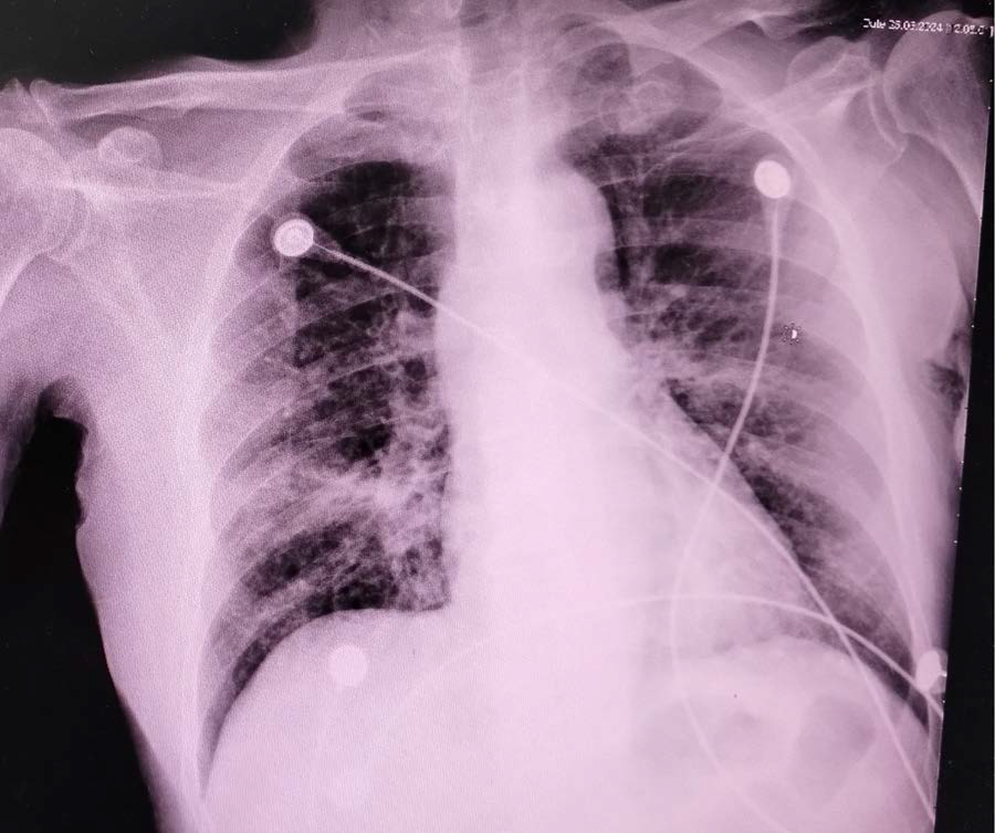 Admission frontal projection expiratory film (AP view) Chest Xray.
