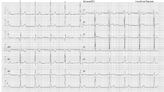 ECG of the child showing sinus rhythm with interpolated PVCs, normal PR interval and flat p waves