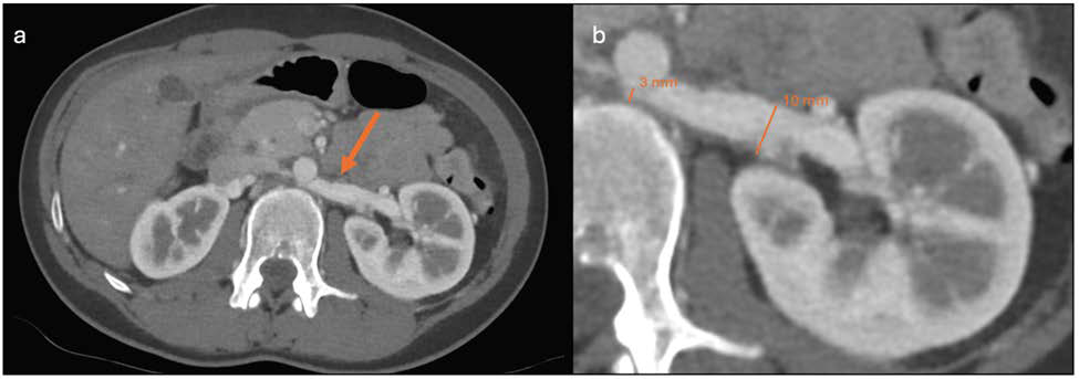 31-year-old female with a retroaortic course of the left renal vein joining the inferior vena cava in the normal position (Type I). Findings: Axial contrast-enhanced CT in the portal venous phase shows a retroaortic left renal vein (orange arrows, image a, magnified in image b) compressed between the aorta and the vertebral body (anteroposterior diameter: 10 vs 3 mm, compression ratio of 1 : 3.3), consistent with posterior nutcracker syndrome. Technique: Axial CT, 150 mAs, 80 kV, 1.25 mm slice thickness, portal venous phase after intravenous injection of 80 ml of iodinated contrast agent (Iohexol 300 mg I/mL).
