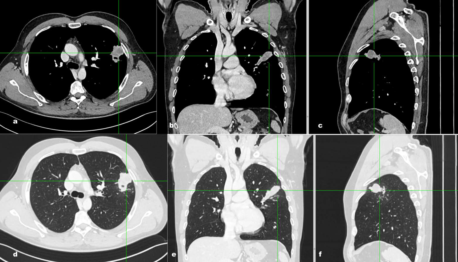 (4a-f) Axial (4a,4d), coronal(4b,4e) and sagittal (4c,4f) thin-section contrast-enhanced CT scan in portal venous phase (4a-4c: mediastinal windowing and lung windowing) shows a parenchymal consolidation measuring 38x44x48 mm in the superior lingular segment of the left upper lobe. This lesion is characterized by irregular margins with strands extending to the hilar region and adjacent pleural plane, it also demonstrates inhomogeneous density due to the presence of colliquative areas.