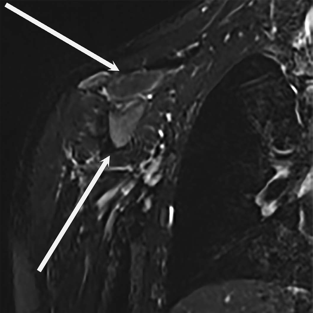 4-year-old boy with Parsonage-Turner Syndrome ? Coronal STIR image of the shoulder girdle demonstrates diffuse hyperintensity within the right supraspinatus and infraspinatus muscles (asterisks), compatible with acute denervation edema ? 3 T MRI, coronal T2 STIR, TR 4917 ms, TE 202 ms, 3-mm slices, no contrast.