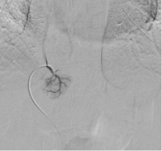 adrenal vein inferior tributary identified on initial AVS. Notably, the vein courses medially from the IVC.