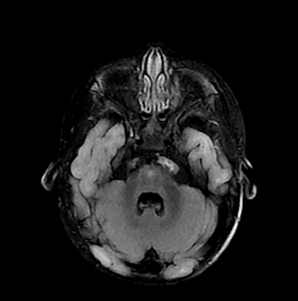 MRI images of axial FLAIR of Twin A show hyperintensity in the pons (a) and ventral medulla