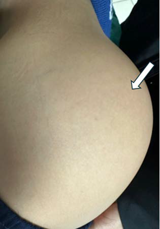 Clinical image of a 10-year-old male patient showing a skin-colored mass measuring approximately 15×15 cm in the left gluteal region (white arrows).