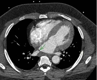  39-year-old male with atrio-esophageal fistula after atrial fibrillation ablation.