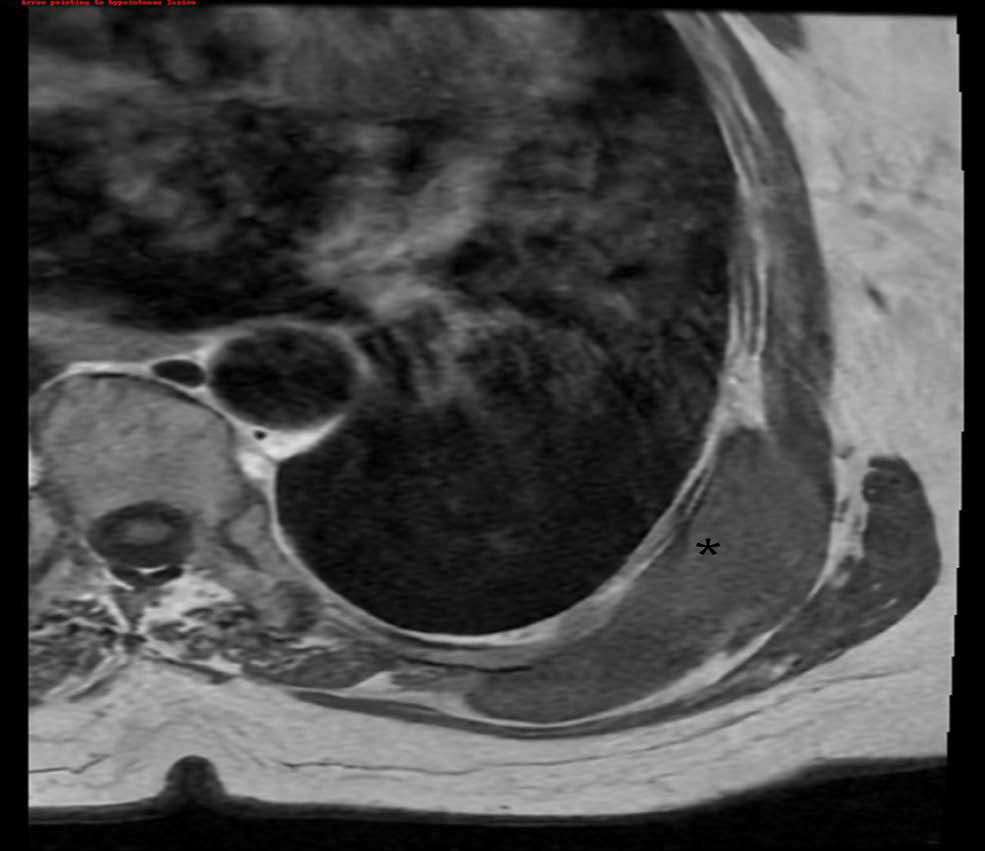 T1 axial view shows a left-sided hypointense lesion beneath the latissimus dorsi marked by the asterisk.