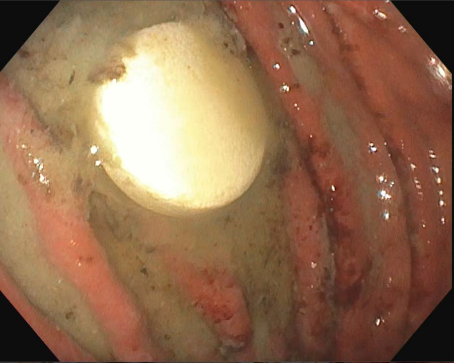 Endoscopic removal of an intact lanthanum carbonate tablet.