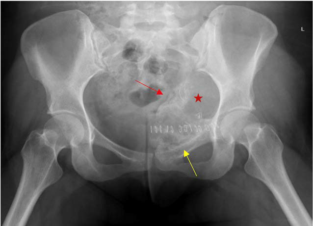 26-year-old female with a mass arising from the superior border of the left superior pubic ramus.