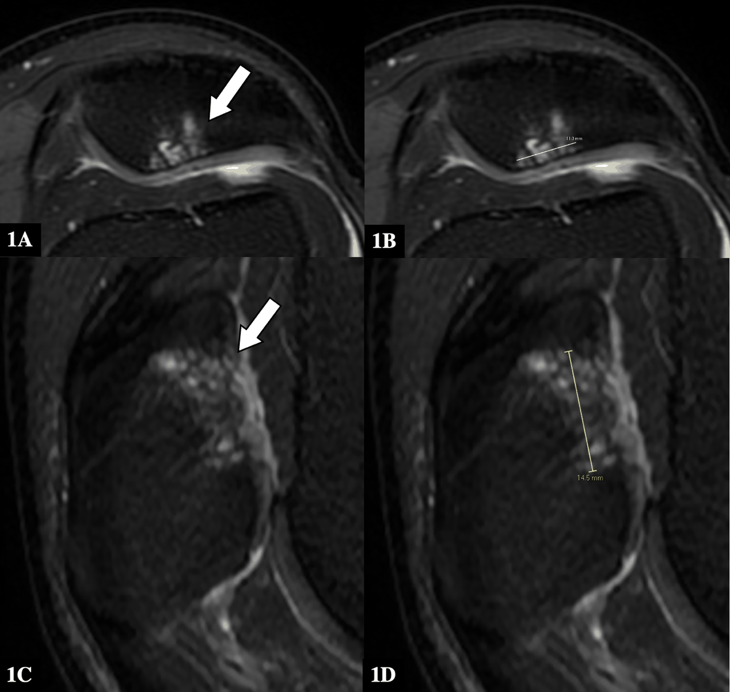 The same 58-year-old male after patellar ridge repair