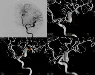 Digital subtraction angiography (DSA) demonstrated a complex fusiform aneurysm (20.3x6.6mm, proximal neck 2.2 mm, distal neck 3.3 mm) in the left M2 MCA segment