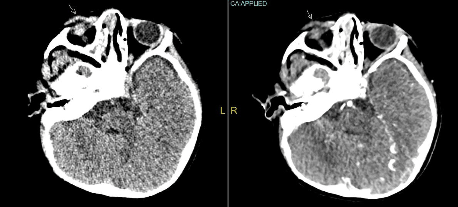 3-year-old boy with right orbital lymphangioma