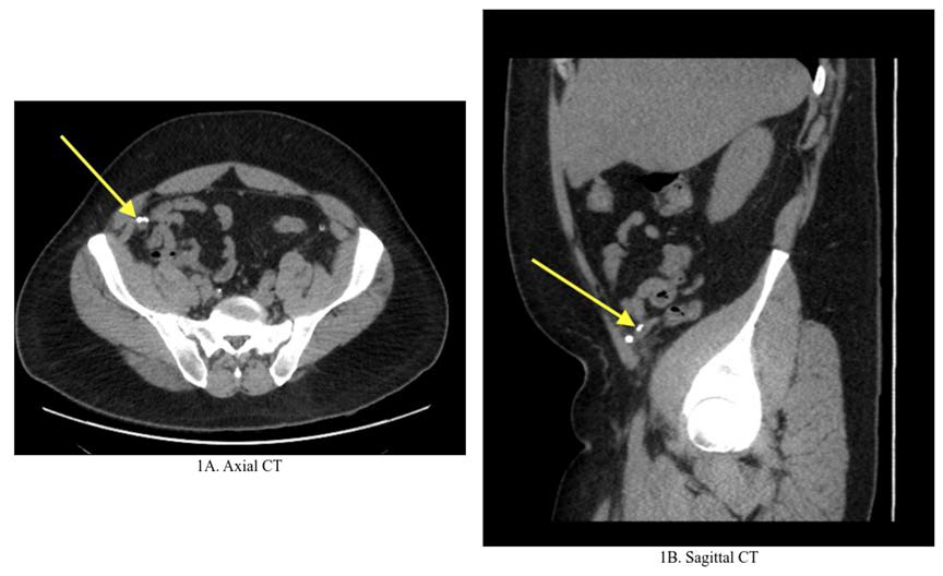 51-year-old male with hernia mesh entrapment of appendix, 3 years prior to acute presentation. FINDINGS: A CT of the abdomen and pelvis from several years prior to presentation with right lower quadrant paint showed the appendix abutting the anterior abdominal wall with an embedded metallic foreign body, but no acute inflammatory changes (yellow arrows). TECHNIQUE: CT Renal Stone Study of the Abdomen and Pelvis without oral or IV contrast. Axial and Sagittal views.