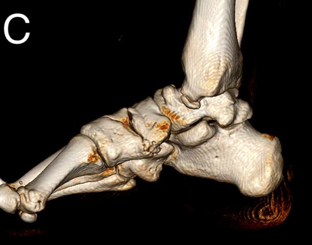 Right navicular–medial cuneiform coalition in a 27-year-old man with chronic foot pain. A. Sagittal PD fat-sat of the right foot shows navicular–medial cuneiform articulation with cortical irregularity, sclerosis, and bone marrow edema. B, C. Sagittal CT (B) and 3D reconstructed image (C) of the same foot further illustrates the coalition.