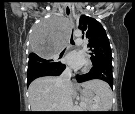 Computed tomography of the thorax (A) Coronal image demonstrates a large, heterogeneously enhancing right apical mass causing mediastinal shift and compression of adjacent structures. (B) Axial image (bone window) widening of right T3 neuroforamina (white arrow).