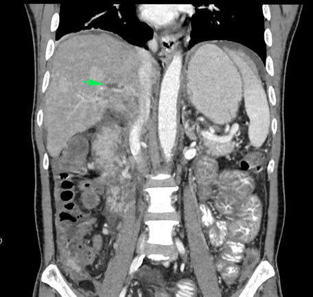 Coronal (A) and transverse (B) contrast-enhanced CT image demonstrates a filling defect within the lumen of the portal vein (arrow), consistent with thrombosis.
