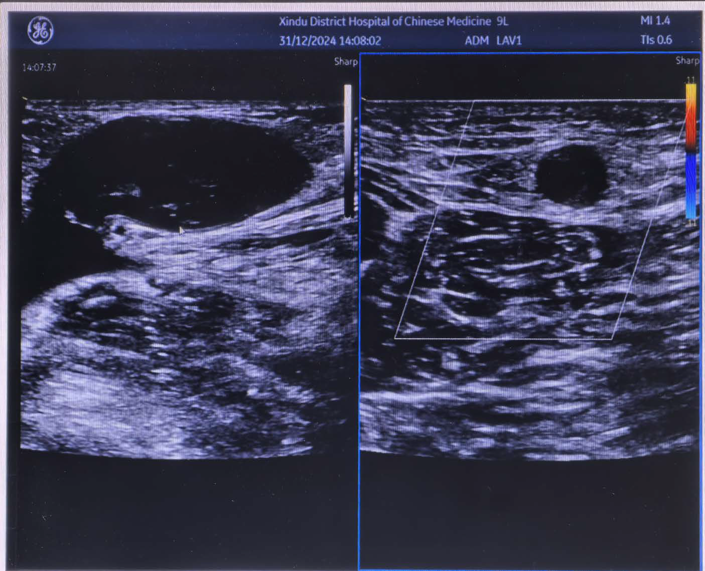 Doppler ultrasound showed significant dilatation of the main trunk of the right great saphenous vein with thrombosis, and no blood flow signal was detected in the lumen