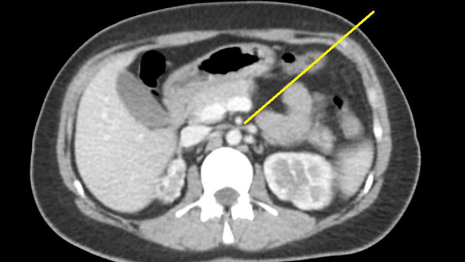A 32-year-old female with Combined Nutcracker Syndrome: Coronal contrast enhanced CT images in venous phase showing entrapment of anterior branch of renal vein between SMA and aorta.